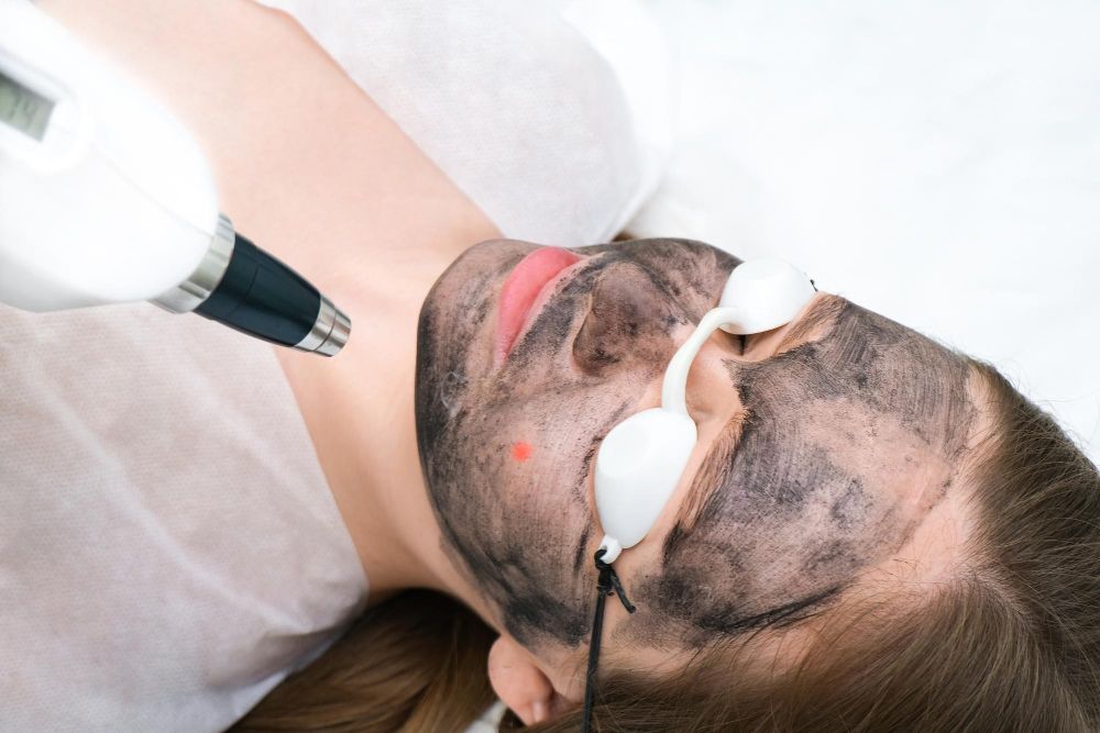 Laserowy peeling węglowy efekty