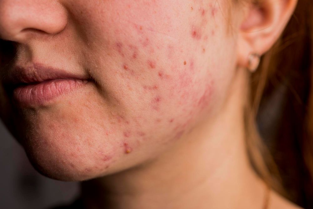 Pasta do zębów na pryszcze podskórne